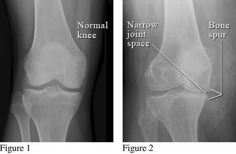 Knee Pain & Osteoarthritis – Amy Chen Registered Physiotherapist